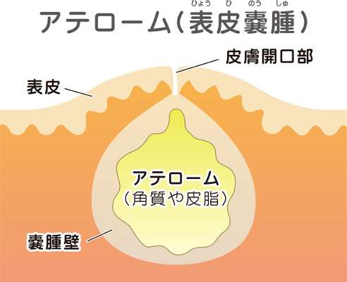 神奈川県藤沢市 鎌倉市 茅ヶ崎市で粉瘤の治療なら池上整形外科